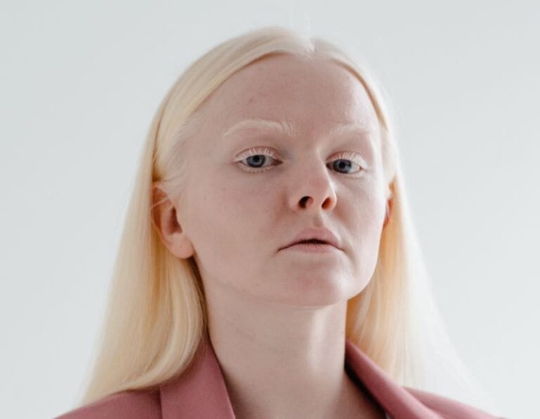 Международный день распространения информации об альбинизме